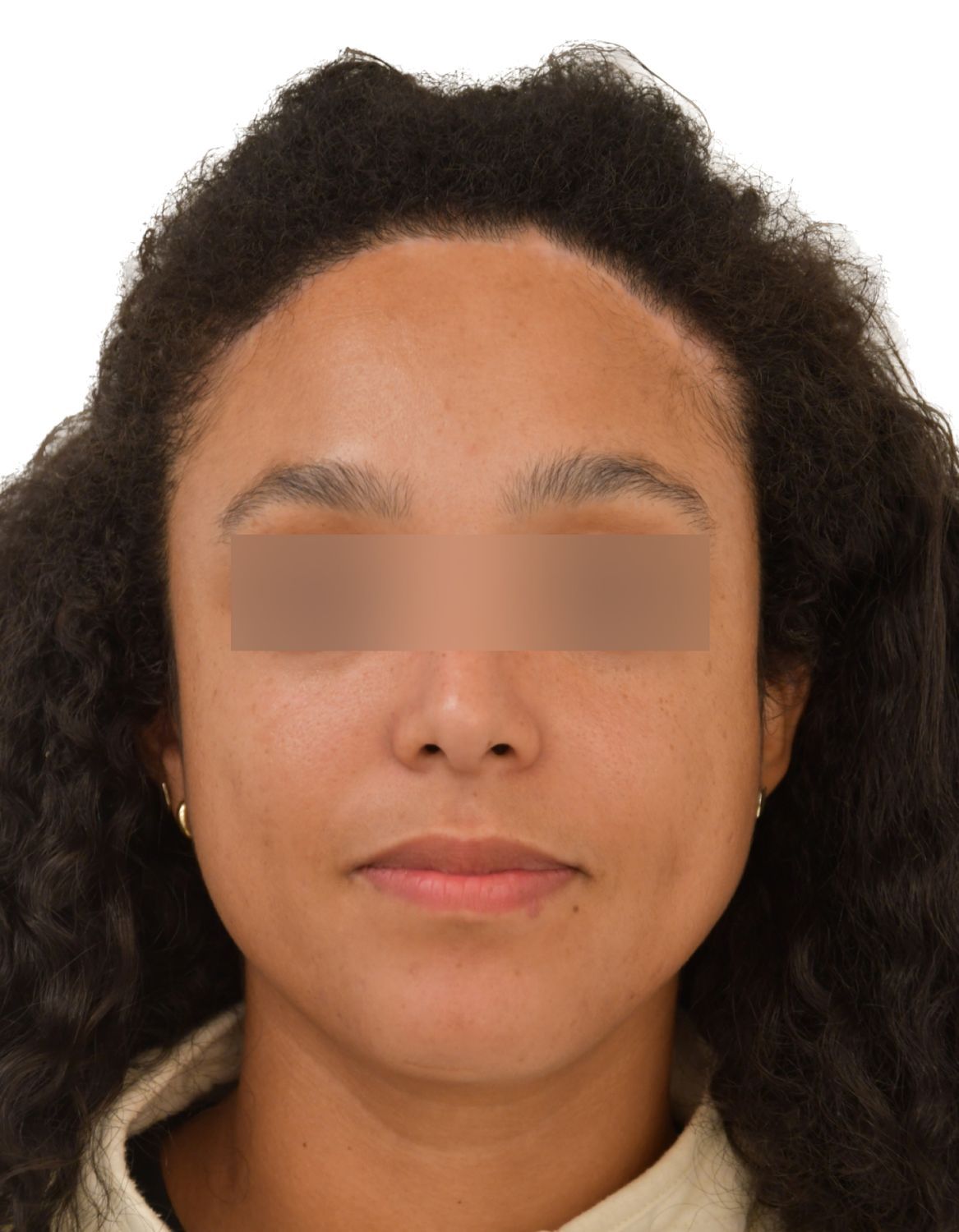 Forehead Reduction Surgery After