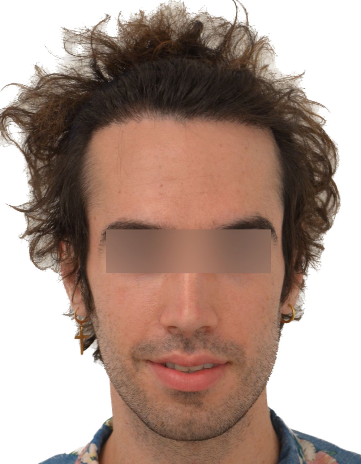 Forehead Reduction Surgery Before