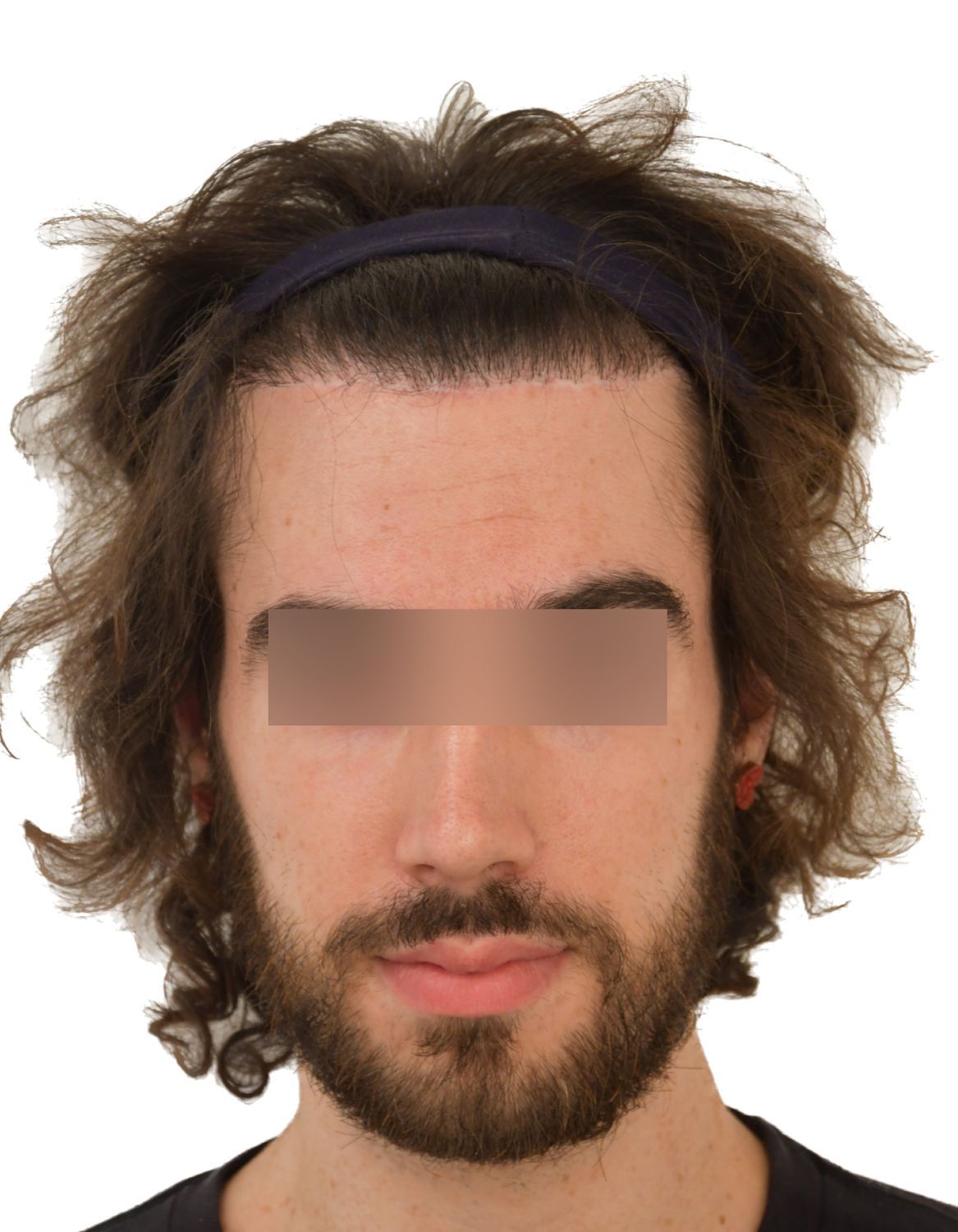 Forehead Reduction Surgery After