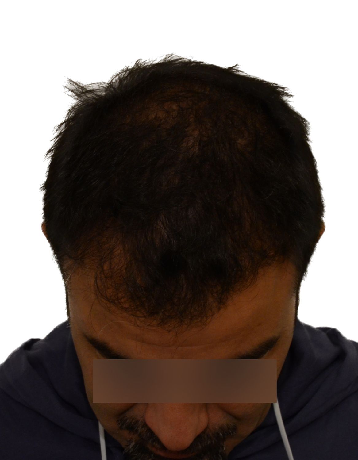 hair transplant after