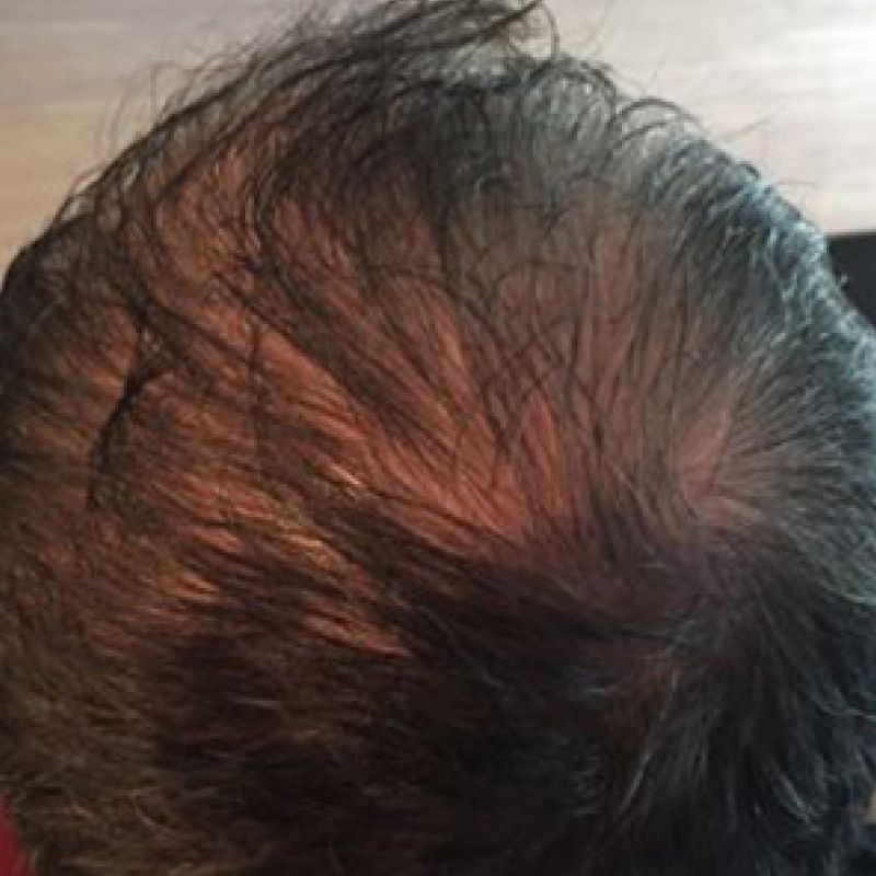 Prp Hair Restoration after