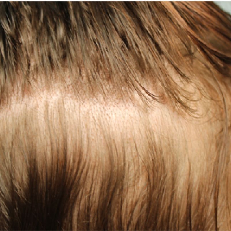 Prp Hair Restoration Before