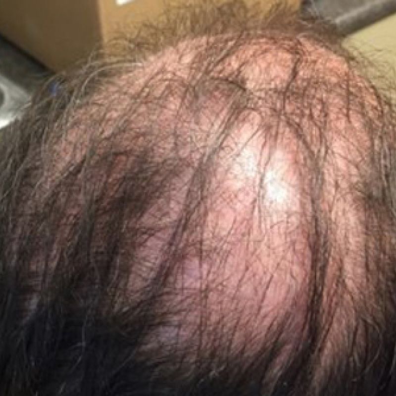 Prp Hair Restoration Before